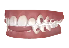 Pare-chocs à lèvres invisible