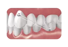 Traction intelligente