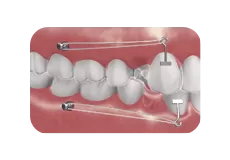 Bras de puissance intelligent et TAD (mini vis)