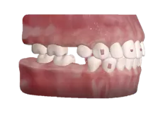 Protocole classique d'extraction de dent