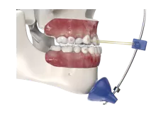 Dispositif de traction de transfert invisible