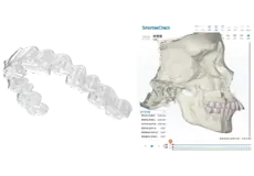 Appareils clairs pour le traitement orthodontique périopératoire