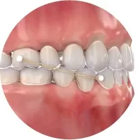 Élastique de classe I