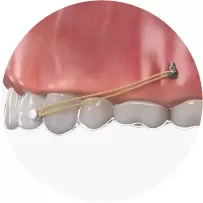 Élastique de classe III