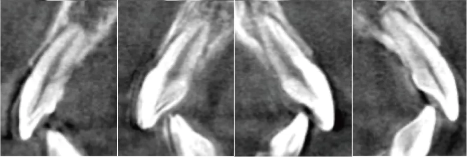Prévenir la fenestration des os et la déhiscence des os
