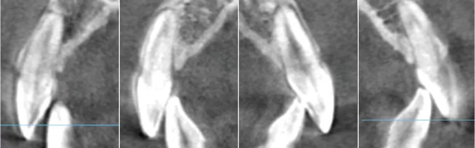 Prévenir la fenestration des os et la déhiscence des os