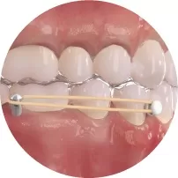 Élastique de classe I