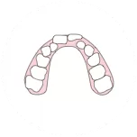 Narrow dental arch and crowded teeth