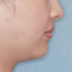 Photos faciales avant le traitement