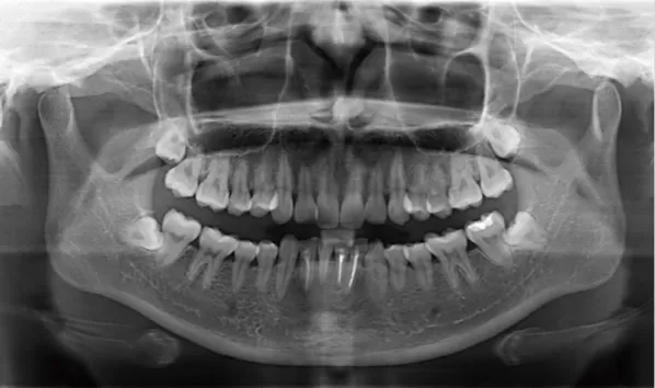 Rayons X avant le traitement