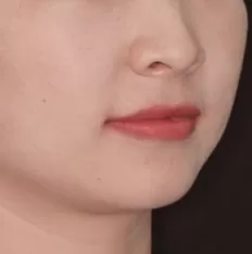 Photos faciales avant le traitement