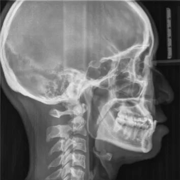 Rayons X avant le traitement