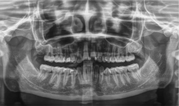 Rayons X avant le traitement