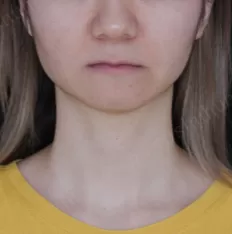 Photos faciales avant le traitement