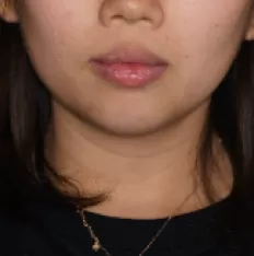 Photos faciales avant le traitement