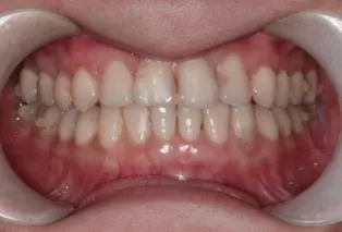 Photos intra-orales après traitement