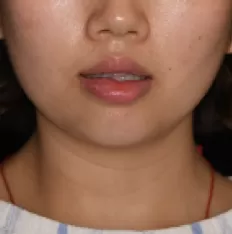 Photos faciales avant le traitement