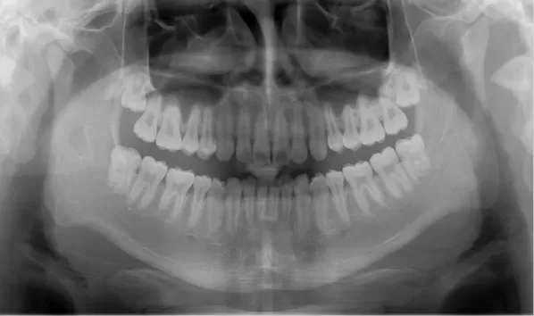 Rayons X avant le traitement