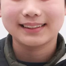 Photos faciales avant le traitement