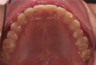 Photos intra-orales après traitement