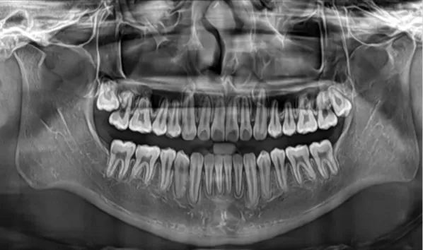 Rayons X avant le traitement