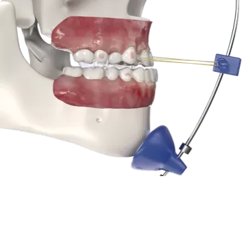 S16 Dispositif invisible de traction de transfert