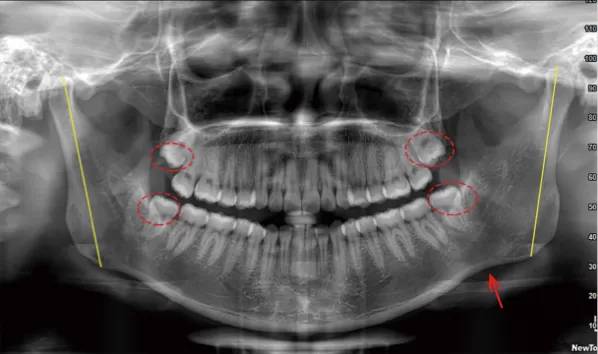 Rayons X avant le traitement