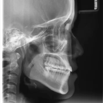 Rayons X avant le traitement