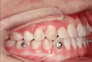 Photos intra-orales après traitement