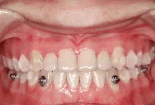 Photos intra-orales après traitement