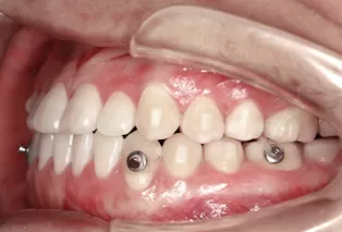 Photos intra-orales après traitement