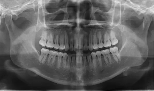 Rayons X avant le traitement