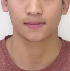 Photos faciales avant le traitement