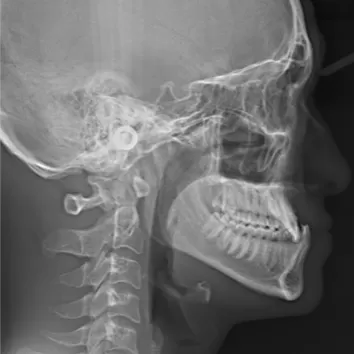 Rayons X avant le traitement