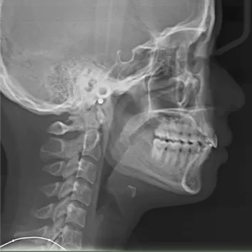 Rayons X avant le traitement