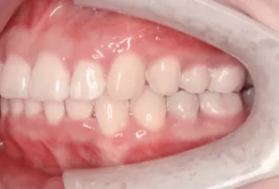 Photos intra-orales après traitement