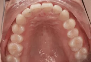 Photos intra-orales après traitement