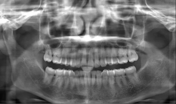 Rayons X avant le traitement