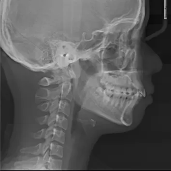 Rayons X avant le traitement