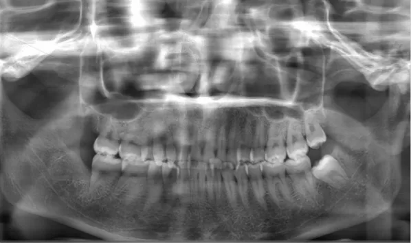 Rayons X avant le traitement