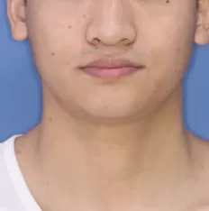 Photos faciales avant le traitement