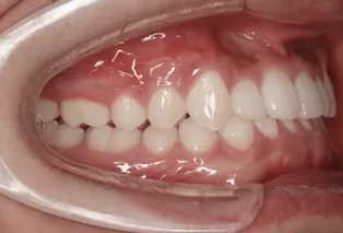 Photos intra-orales après traitement