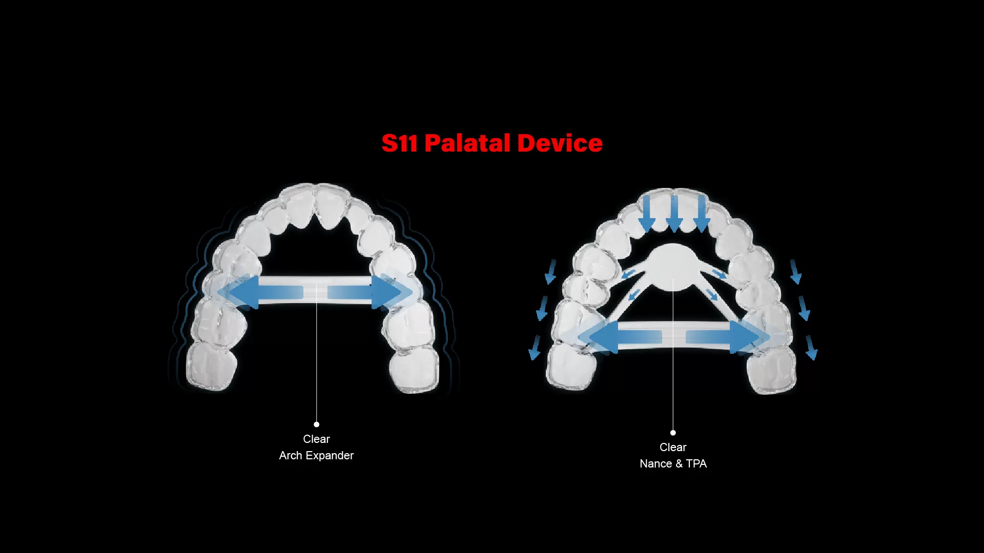 S11 Dispositif Palatal