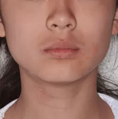 Photos faciales avant le traitement