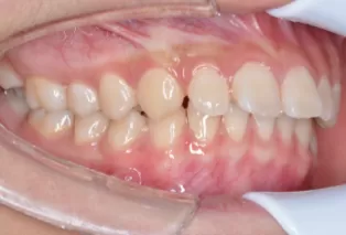 teeth straightening aligners 4