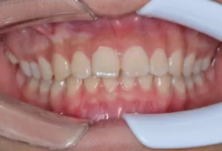 teeth straightening aligners 5