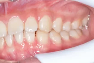 teeth straightening aligners 6