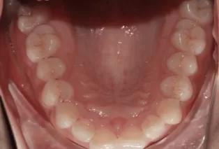 teeth straightening aligners 8