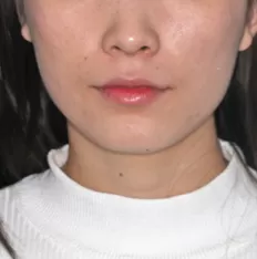 Photos faciales avant le traitement