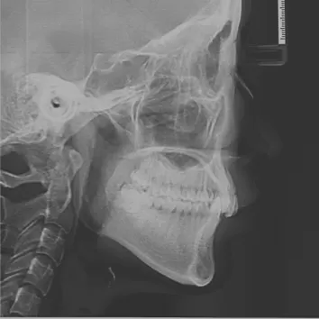 Rayons X avant le traitement